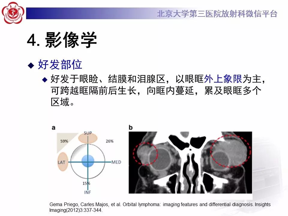 【病例】眼眶淋巴瘤1例CT影像表现