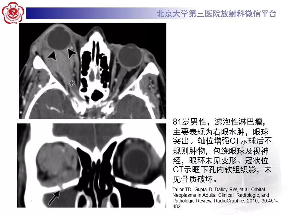 【病例】眼眶淋巴瘤1例CT影像表现
