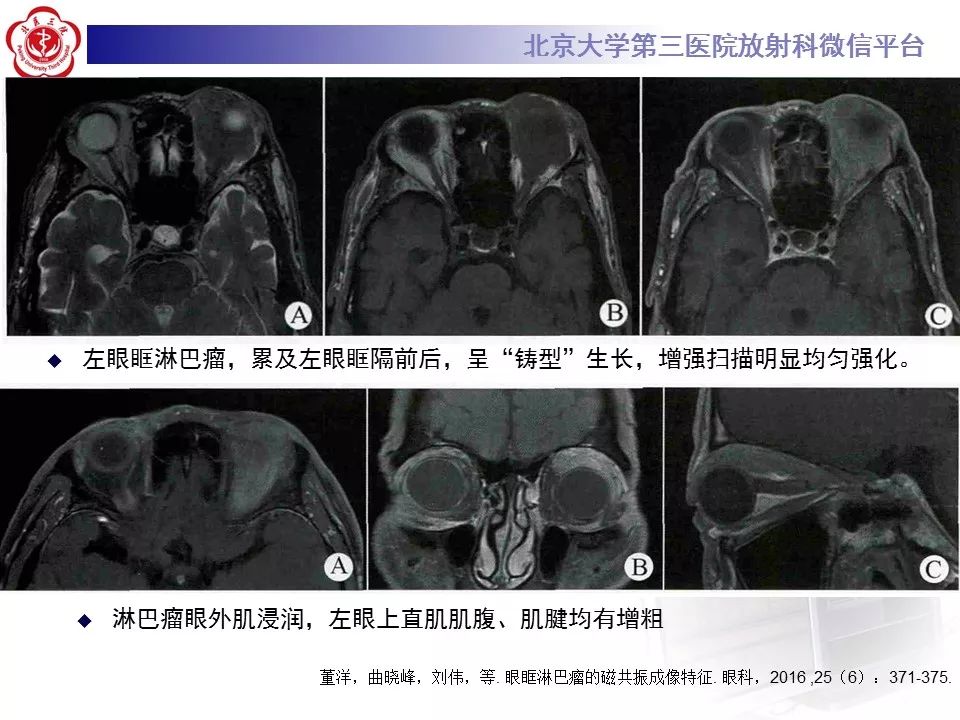 【病例】眼眶淋巴瘤1例CT影像表现