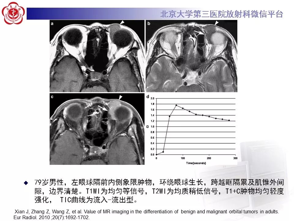 【病例】眼眶淋巴瘤1例CT影像表现