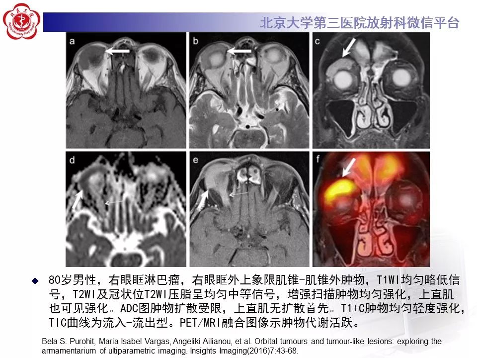 【病例】眼眶淋巴瘤1例CT影像表现