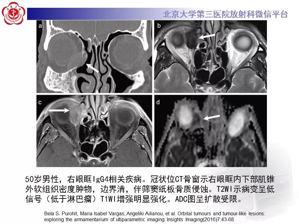【病例】眼眶淋巴瘤1例CT影像表现