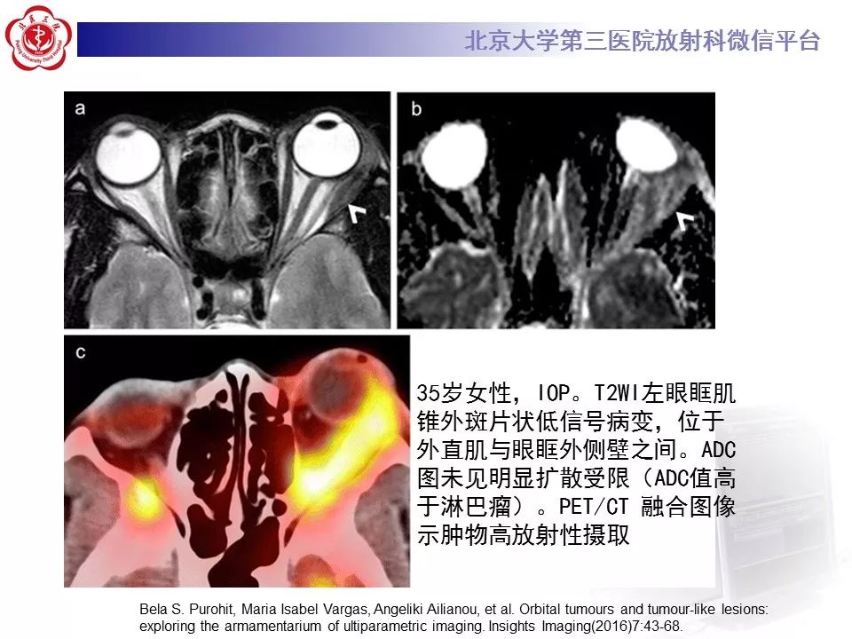 【病例】眼眶淋巴瘤1例CT影像表现