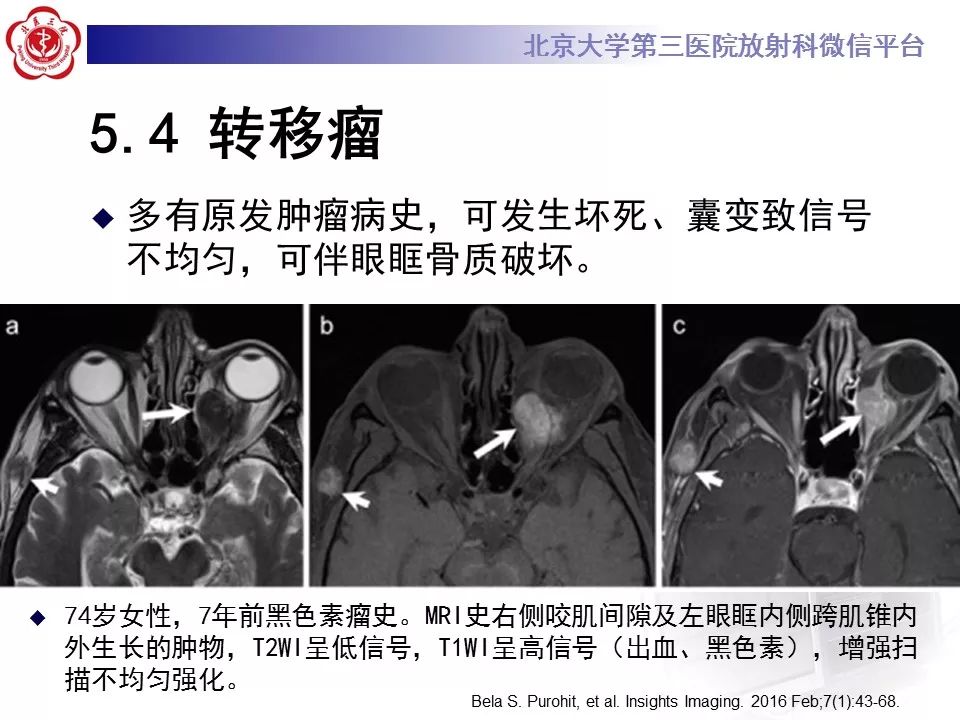 【病例】眼眶淋巴瘤1例CT影像表现