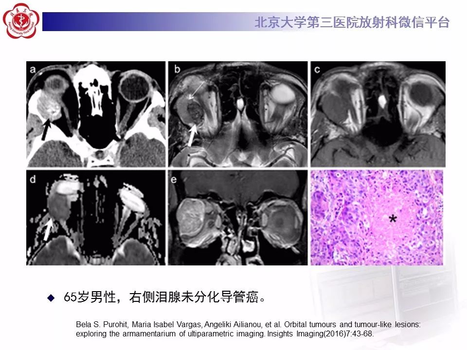 【病例】眼眶淋巴瘤1例CT影像表现