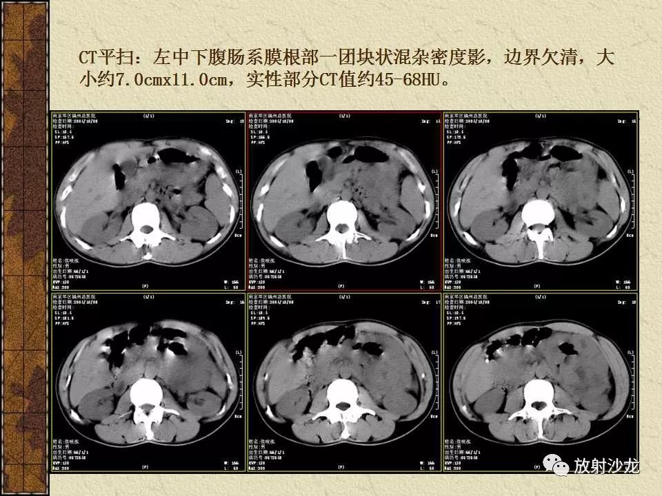 【病例】胃肠道外恶性间质瘤1例CT