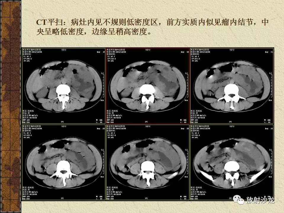 【病例】胃肠道外恶性间质瘤1例CT