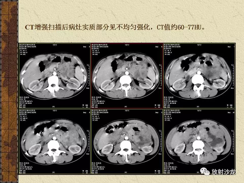 【病例】胃肠道外恶性间质瘤1例CT