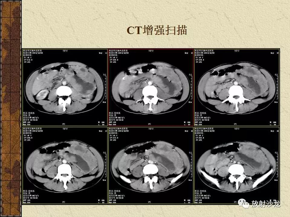 【病例】胃肠道外恶性间质瘤1例CT