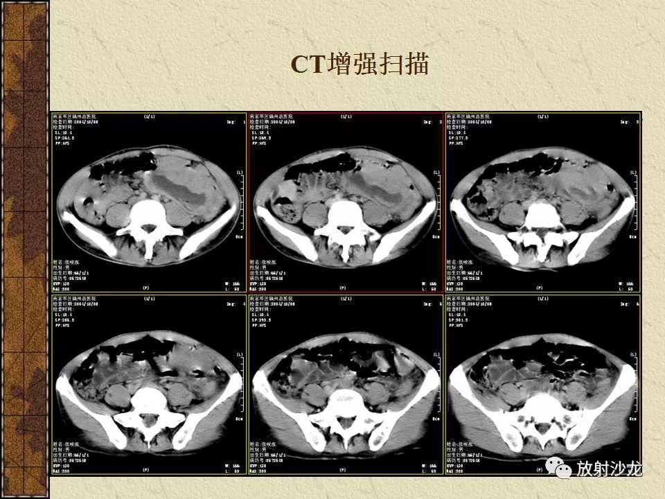 【病例】胃肠道外恶性间质瘤1例CT