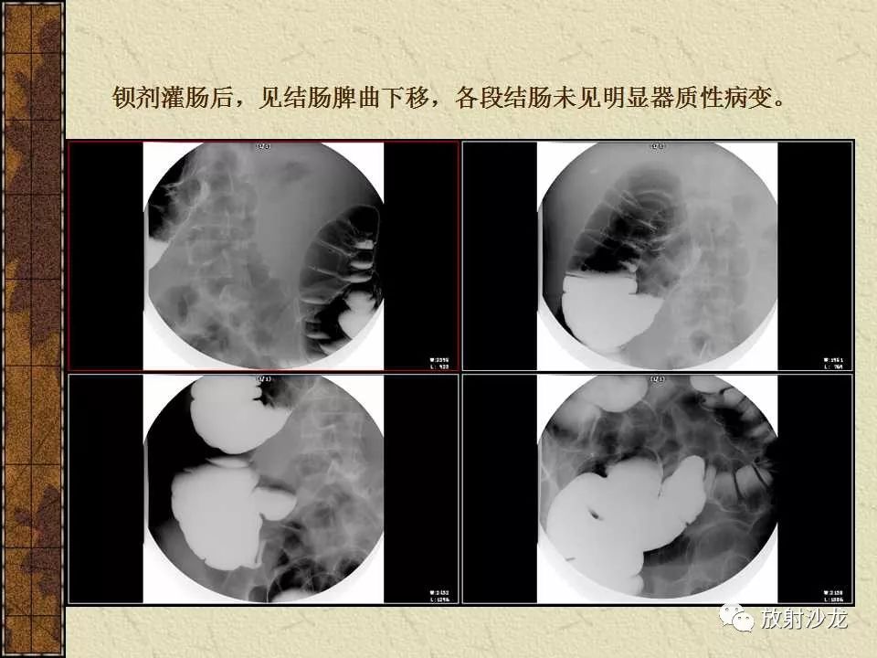 【病例】胃肠道外恶性间质瘤1例CT