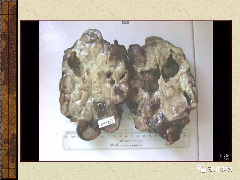 【病例】胃肠道外恶性间质瘤1例CT