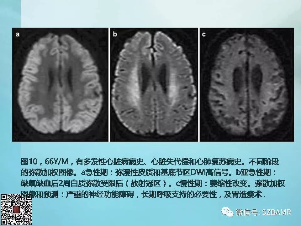 【PPT】非新生儿缺氧缺血性脑病的病理生理学改变及CT和MRI表现