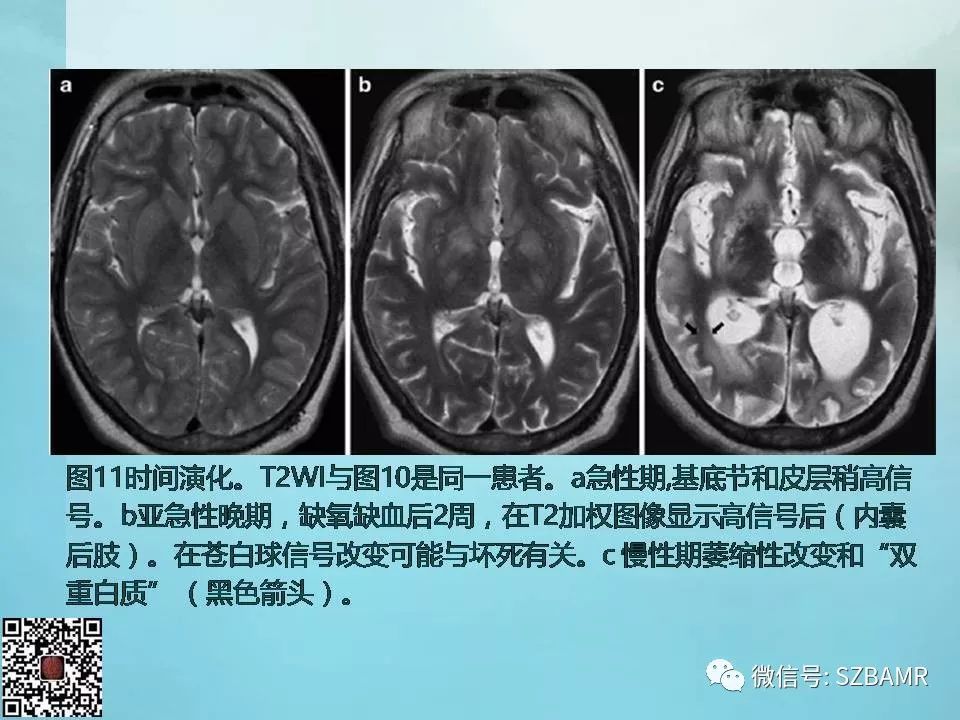 【PPT】非新生儿缺氧缺血性脑病的病理生理学改变及CT和MRI表现