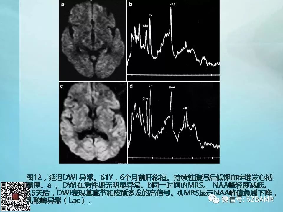 【PPT】非新生儿缺氧缺血性脑病的病理生理学改变及CT和MRI表现