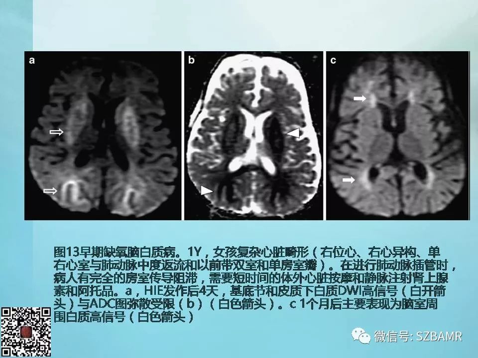 【PPT】非新生儿缺氧缺血性脑病的病理生理学改变及CT和MRI表现