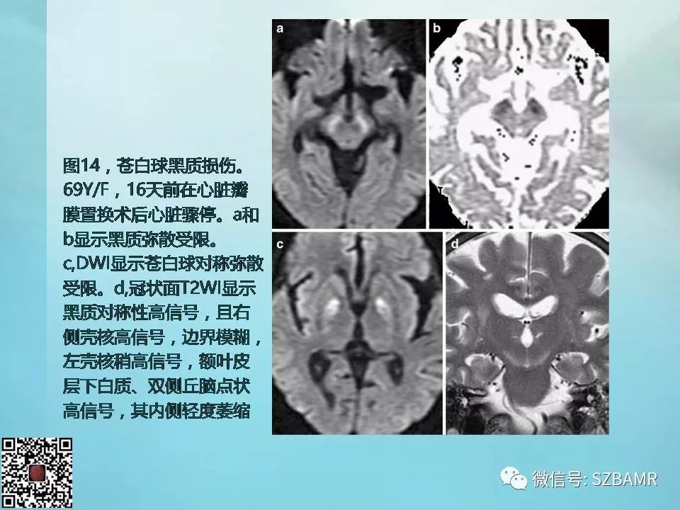【PPT】非新生儿缺氧缺血性脑病的病理生理学改变及CT和MRI表现