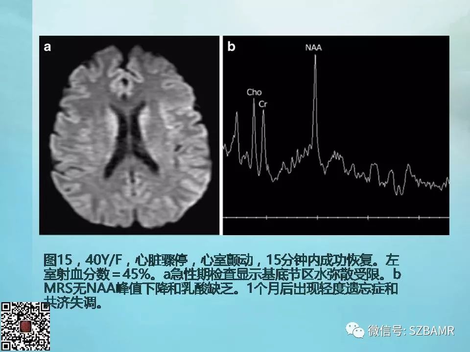 【PPT】非新生儿缺氧缺血性脑病的病理生理学改变及CT和MRI表现