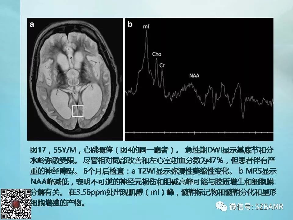 【PPT】非新生儿缺氧缺血性脑病的病理生理学改变及CT和MRI表现