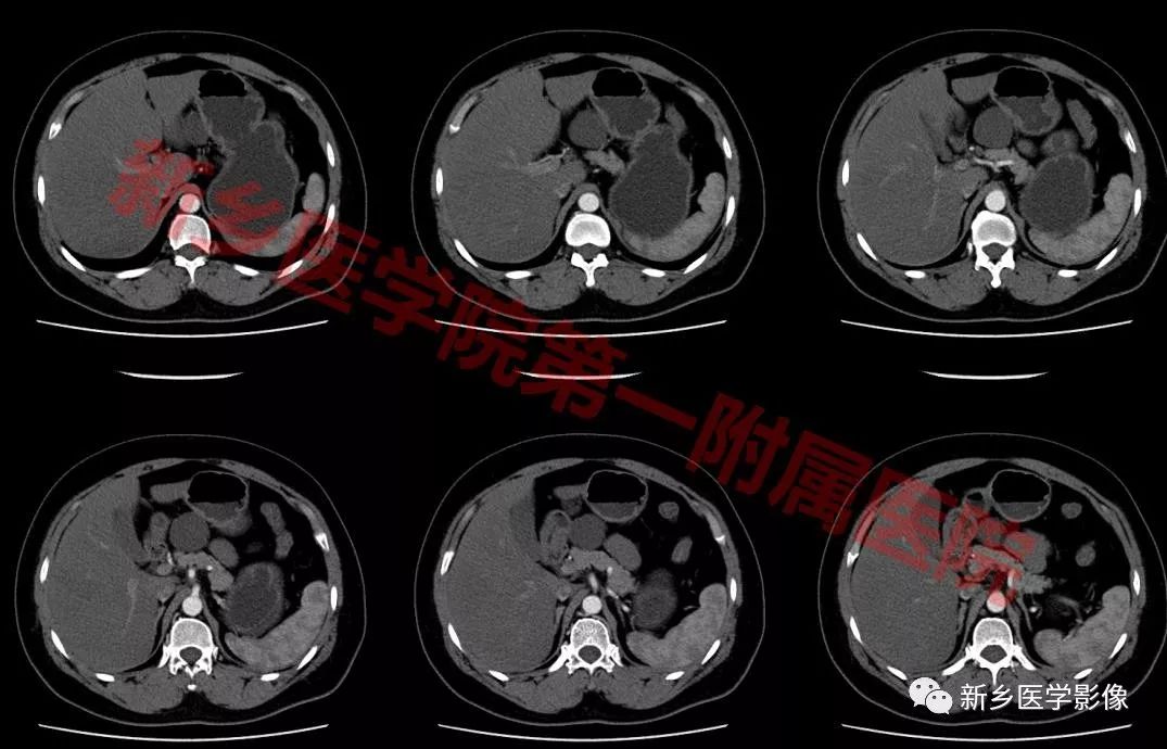【病例】腹膜后淋巴管瘤1例CT影像诊断 【病例】腹膜后淋巴管瘤1例CT影像诊断