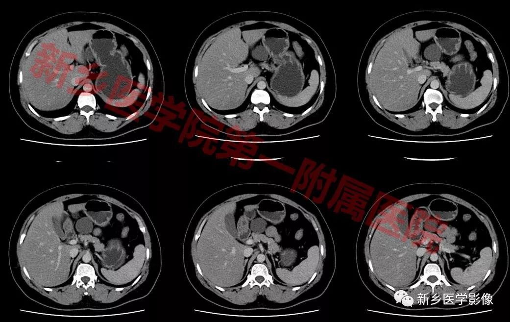 【病例】腹膜后淋巴管瘤1例CT影像诊断 【病例】腹膜后淋巴管瘤1例CT影像诊断