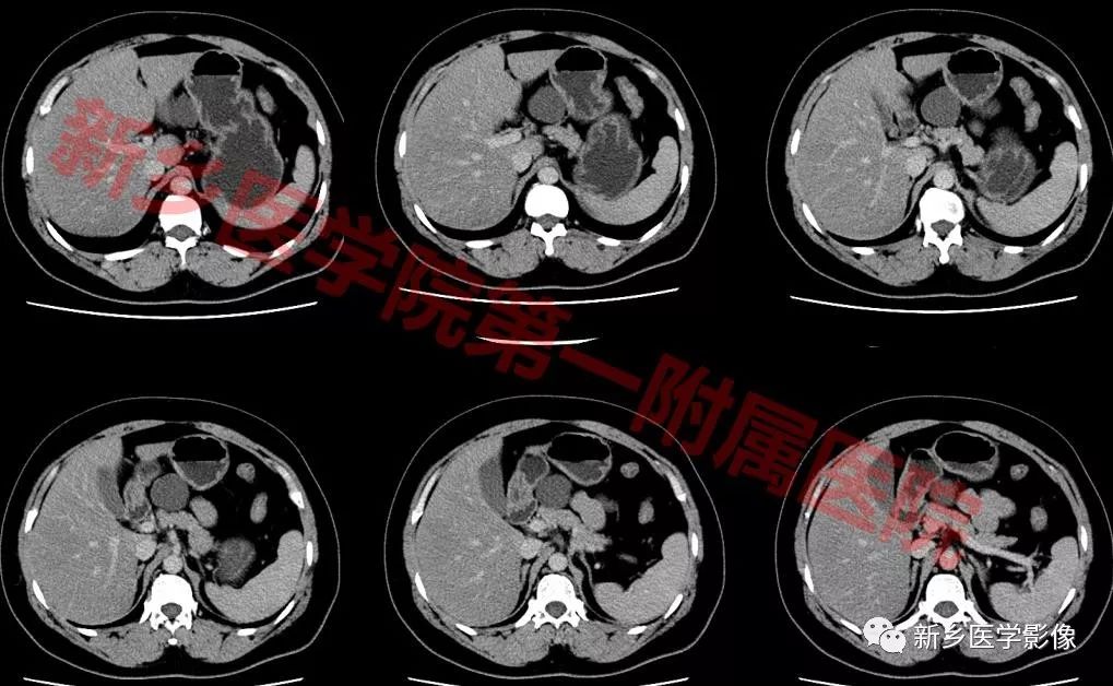 【病例】腹膜后淋巴管瘤1例CT影像诊断 【病例】腹膜后淋巴管瘤1例CT影像诊断