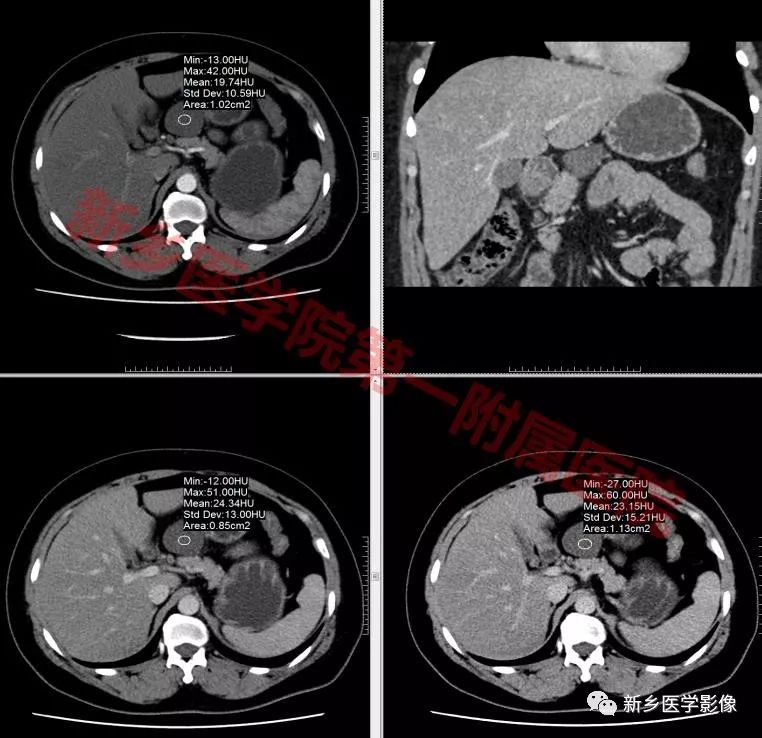 【病例】腹膜后淋巴管瘤1例CT影像诊断 【病例】腹膜后淋巴管瘤1例CT影像诊断