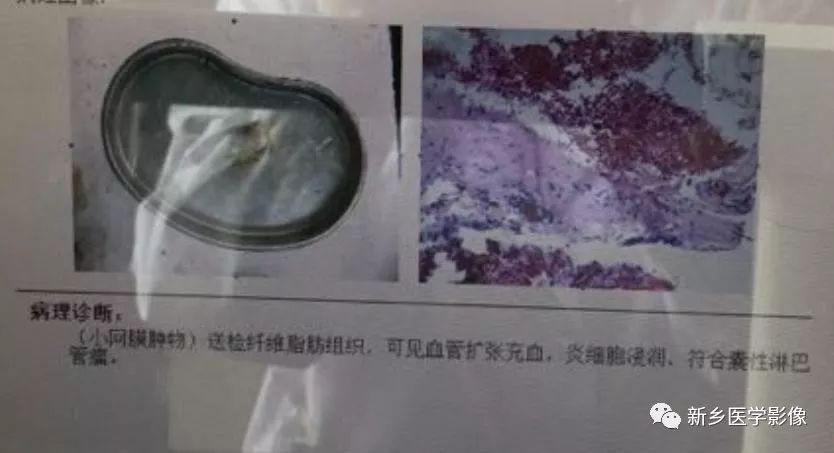 【病例】腹膜后淋巴管瘤1例CT影像诊断 【病例】腹膜后淋巴管瘤1例CT影像诊断