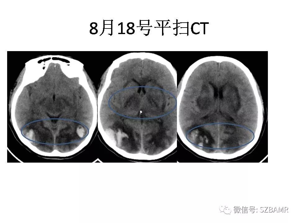 【PPT】一例可逆性脑血管收缩综合症(RCVS)诊治中的思考