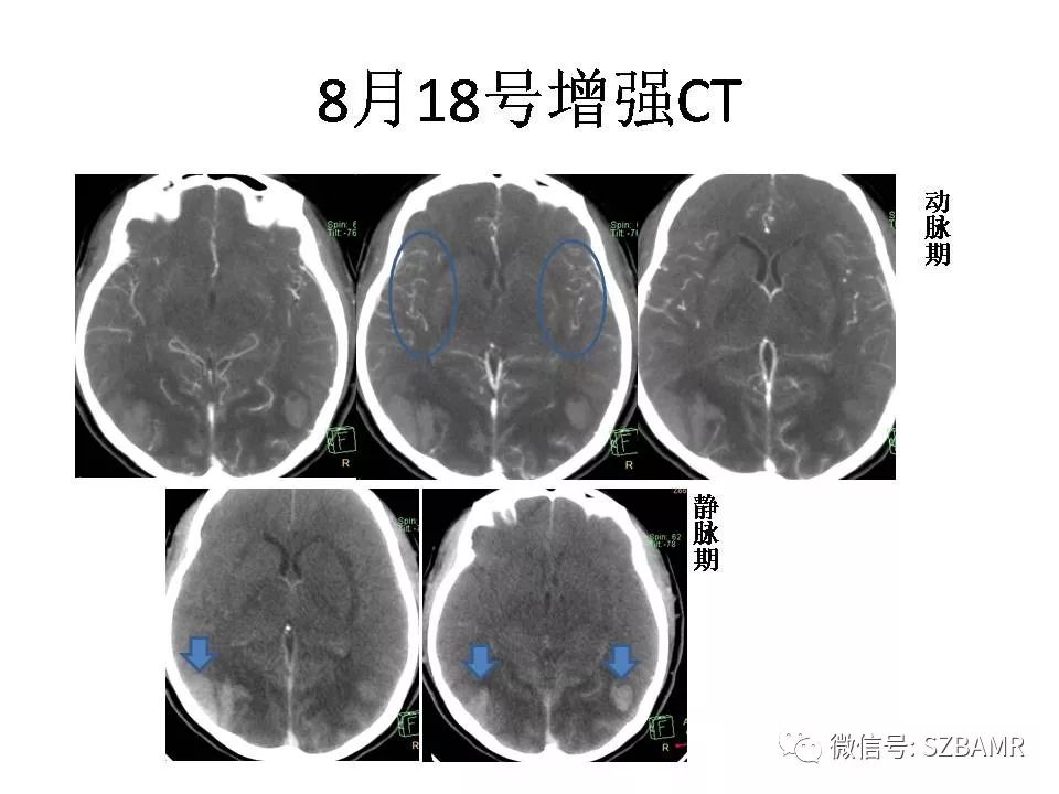 【PPT】一例可逆性脑血管收缩综合症(RCVS)诊治中的思考