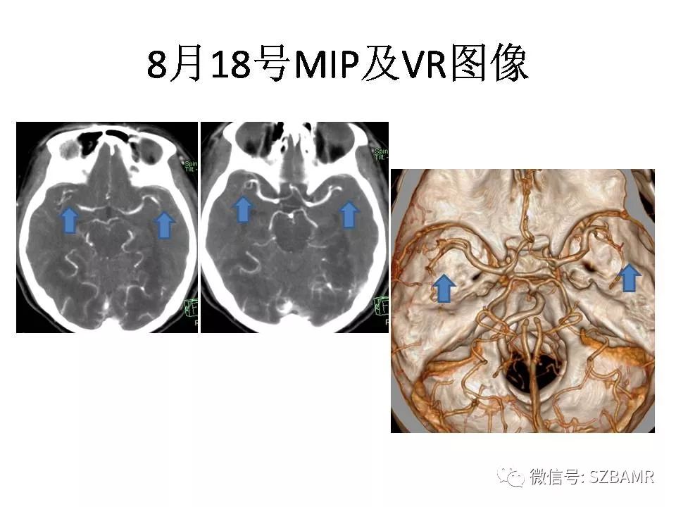 【PPT】一例可逆性脑血管收缩综合症(RCVS)诊治中的思考