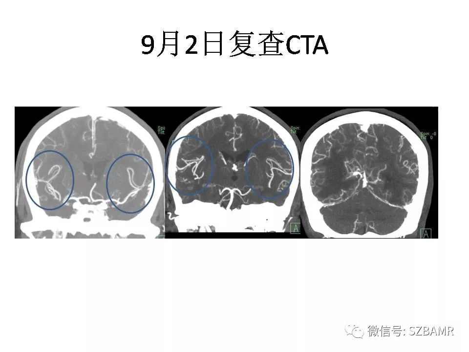 【PPT】一例可逆性脑血管收缩综合症(RCVS)诊治中的思考