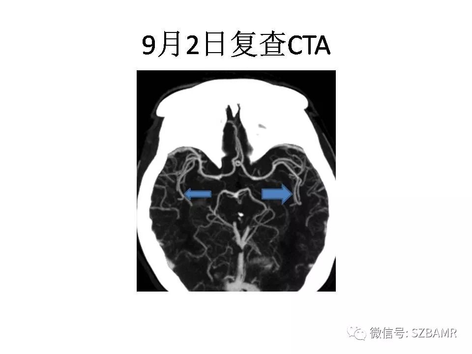 【PPT】一例可逆性脑血管收缩综合症(RCVS)诊治中的思考