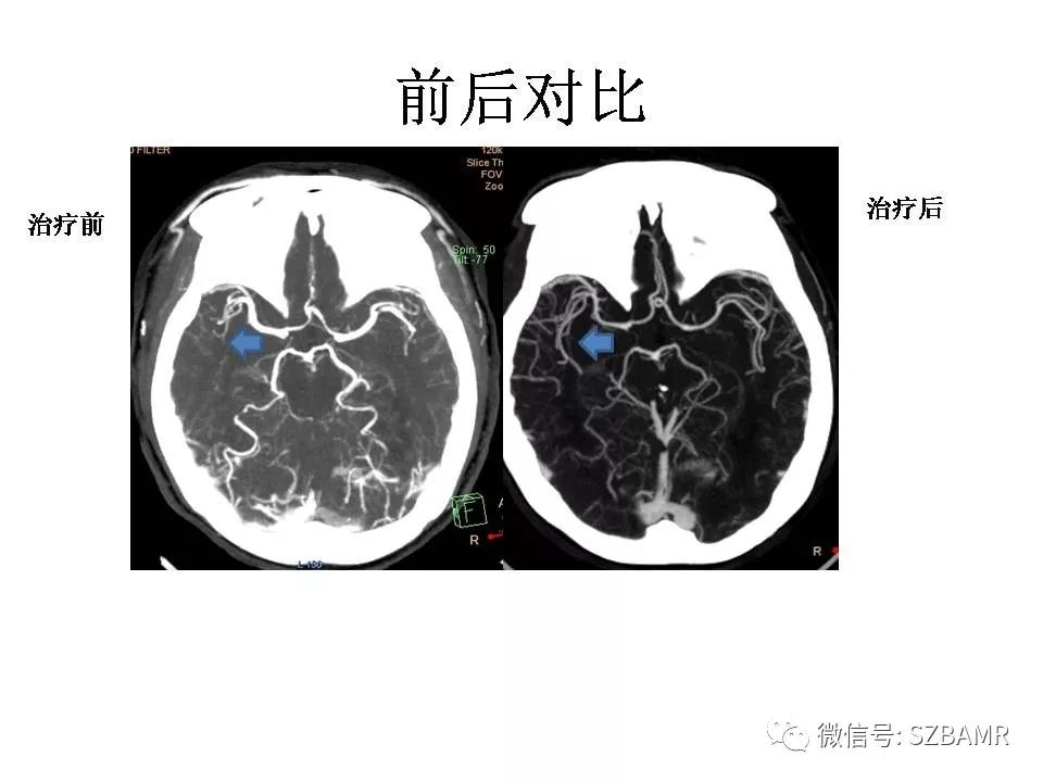 【PPT】一例可逆性脑血管收缩综合症(RCVS)诊治中的思考