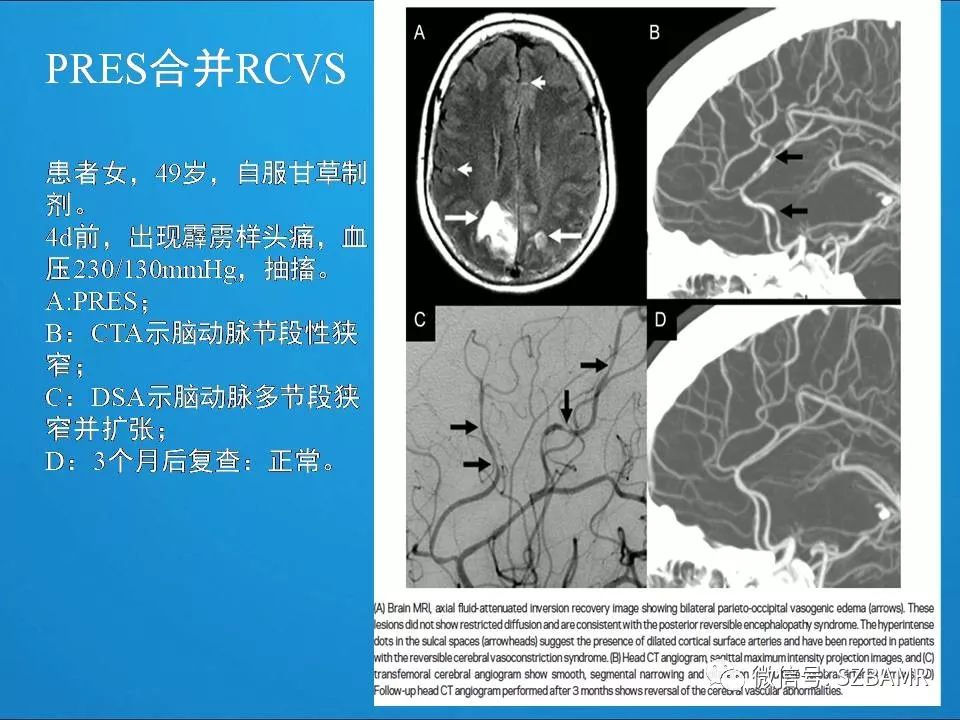 【PPT】一例可逆性脑血管收缩综合症(RCVS)诊治中的思考