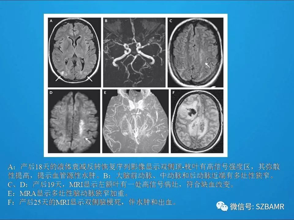 【PPT】一例可逆性脑血管收缩综合症(RCVS)诊治中的思考