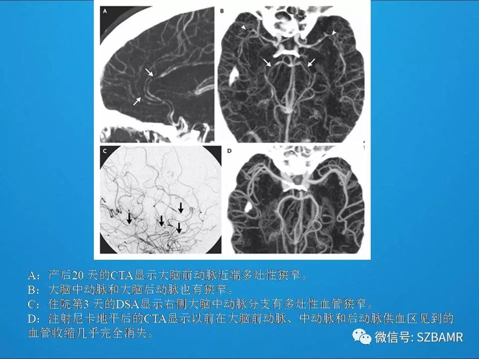 【PPT】一例可逆性脑血管收缩综合症(RCVS)诊治中的思考