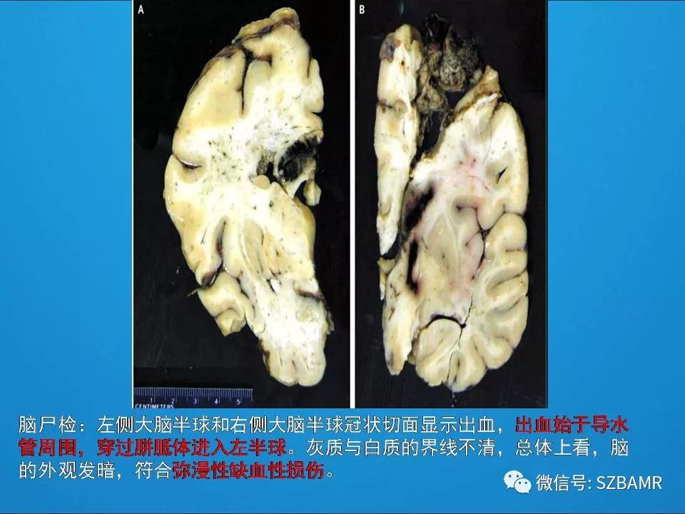 【PPT】一例可逆性脑血管收缩综合症(RCVS)诊治中的思考