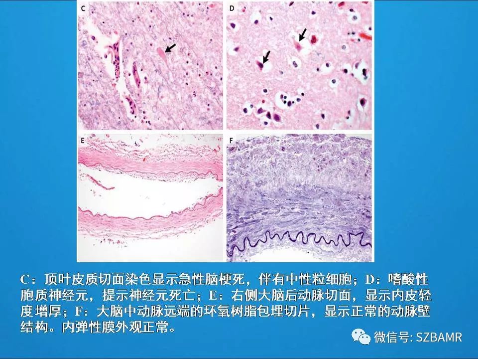 【PPT】一例可逆性脑血管收缩综合症(RCVS)诊治中的思考