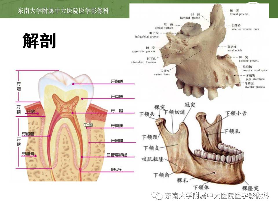 【病例】上颌骨造釉细胞瘤1例CT影像表现