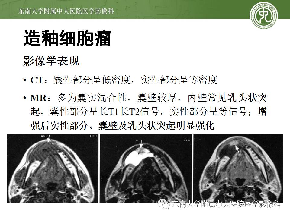【病例】上颌骨造釉细胞瘤1例CT影像表现