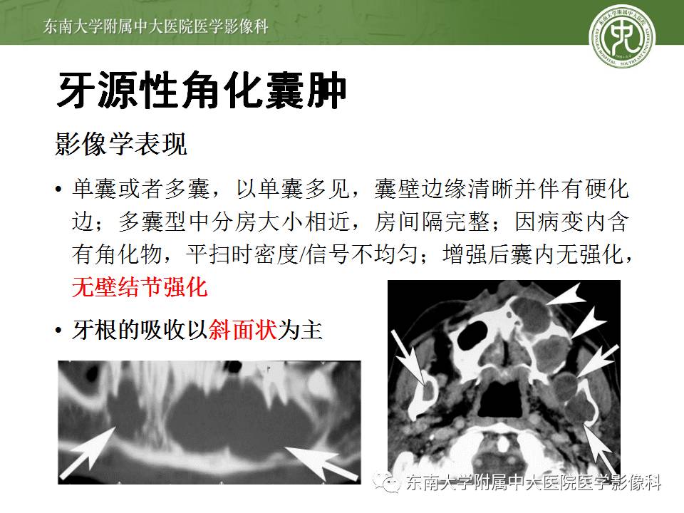 【病例】上颌骨造釉细胞瘤1例CT影像表现