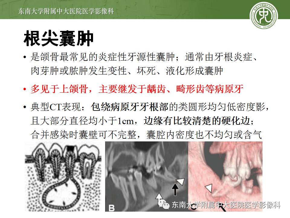 【病例】上颌骨造釉细胞瘤1例CT影像表现