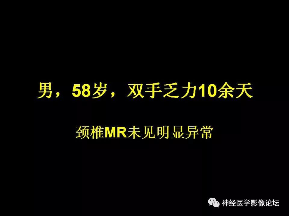 【病例】右额叶脑挫裂伤一例MR及CT