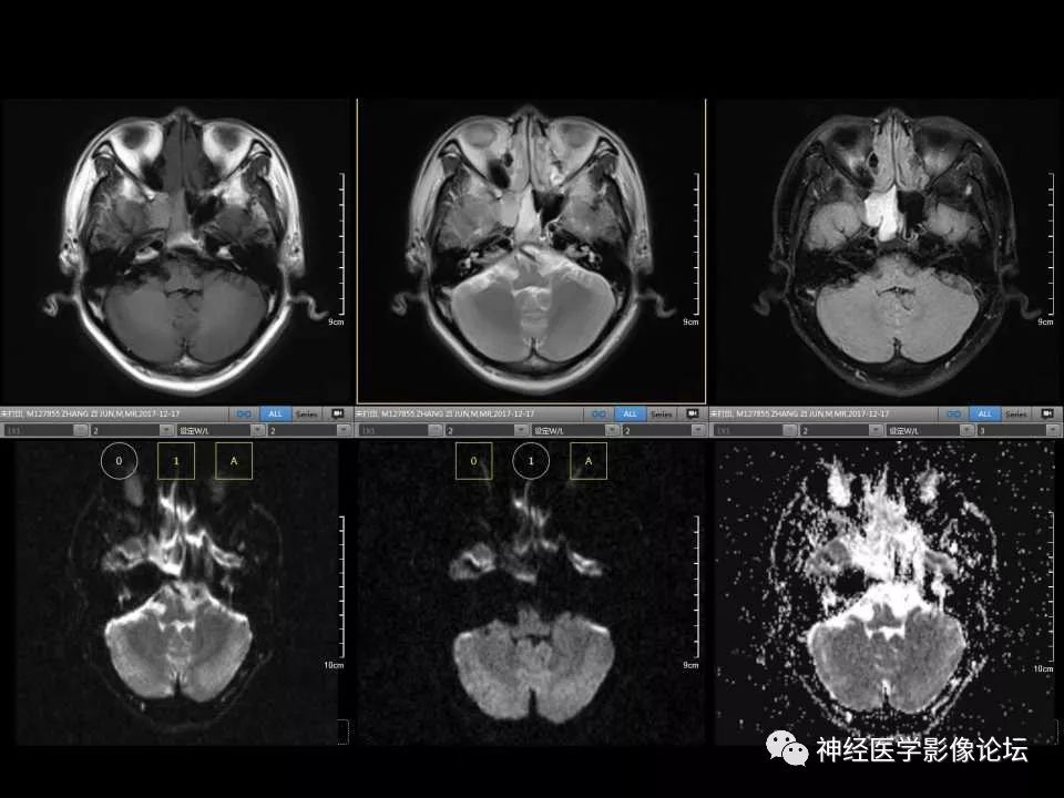 【病例】右额叶脑挫裂伤一例MR及CT