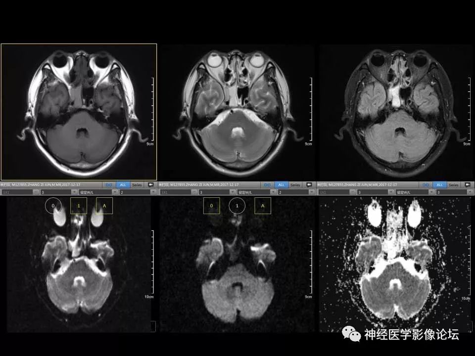 【病例】右额叶脑挫裂伤一例MR及CT