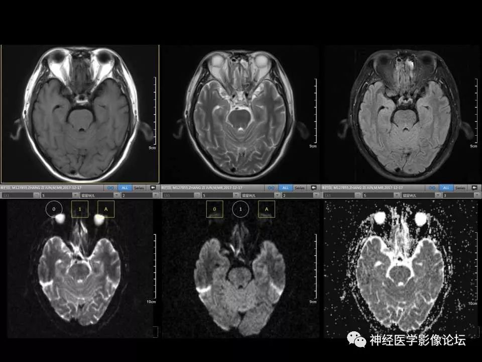 【病例】右额叶脑挫裂伤一例MR及CT
