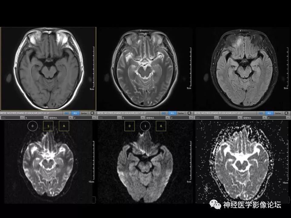 【病例】右额叶脑挫裂伤一例MR及CT