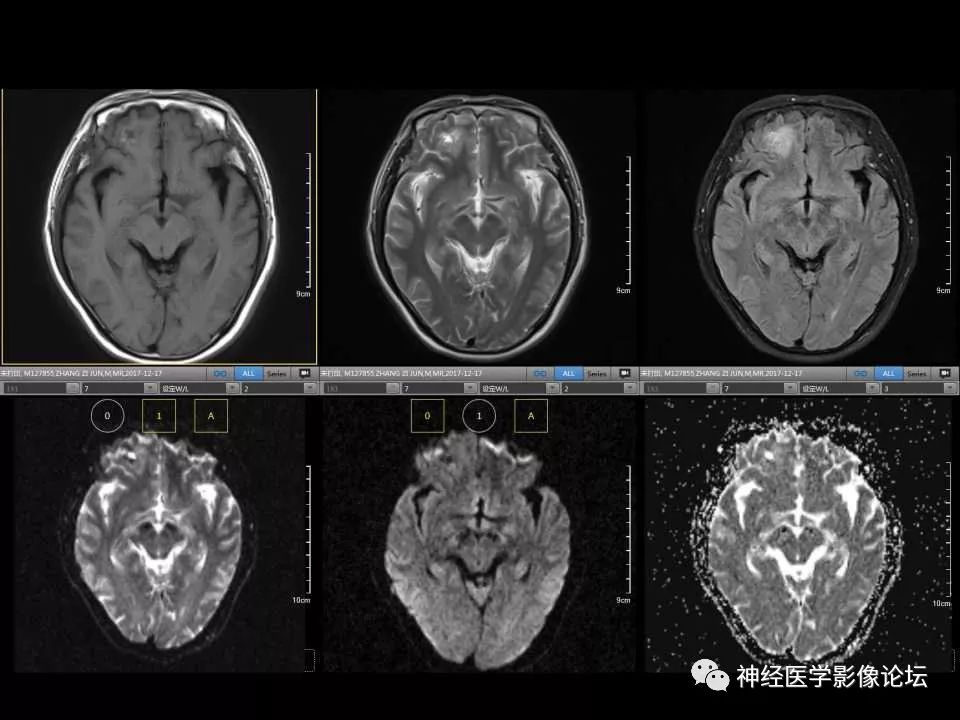 【病例】右额叶脑挫裂伤一例MR及CT
