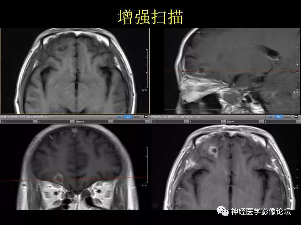 【病例】右额叶脑挫裂伤一例MR及CT